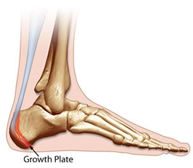 calcaneus hurts