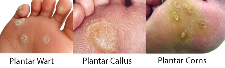 Plantar warts, plantar calluses and plantar corns