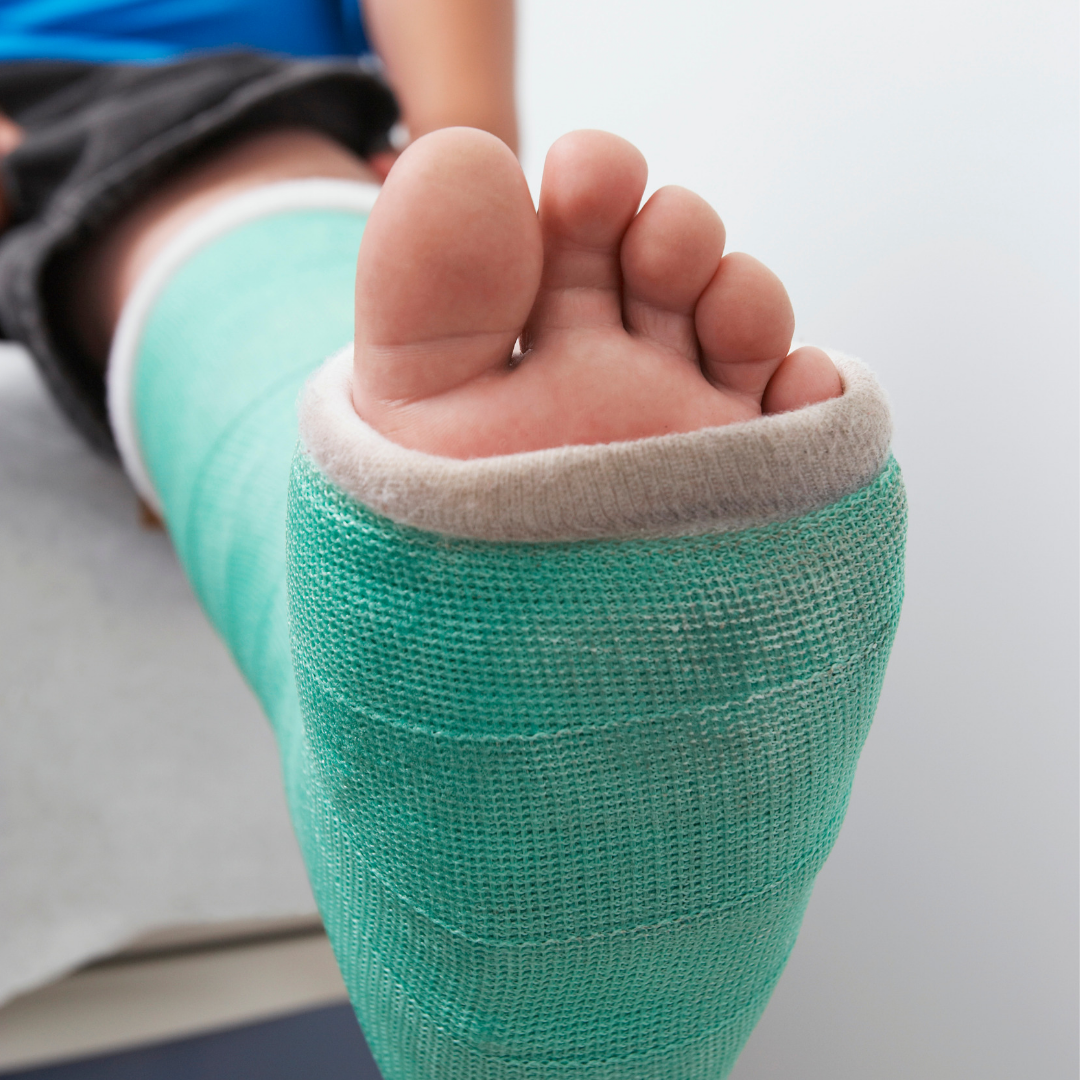 A fracture is a break in the bone. 
