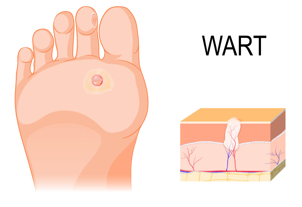 What Kind Of Doctor For A Plantars Wart 43 Wedding Ideas You Have