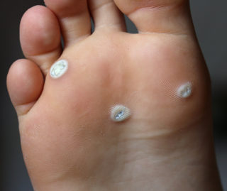 Plantar warts