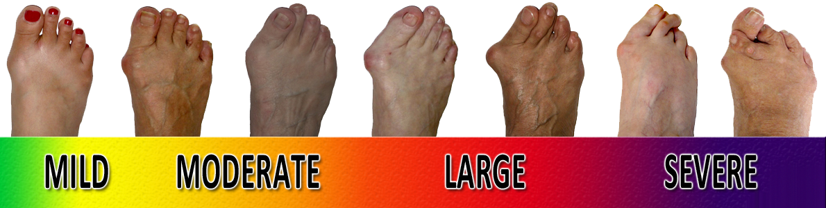 Foot bunions
