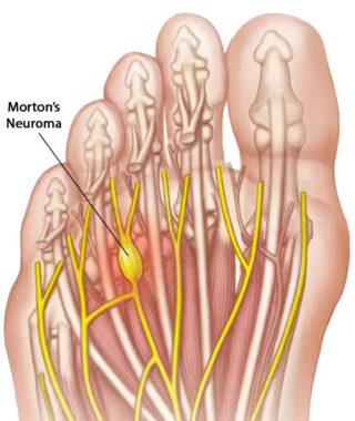 Morton's Neuroma