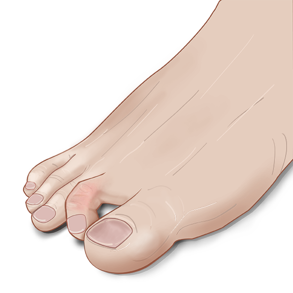 Claw toe treatment in Cleveland, Ohio.