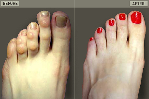 Hammertoe treatment in Cleveland, Ohio.