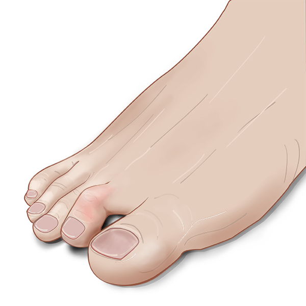 Hammertoe treatment in Cleveland, Ohio.