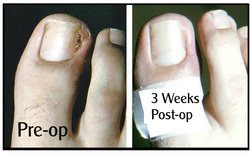 Ingrown Toenail treatment in Cleveland, Ohio.