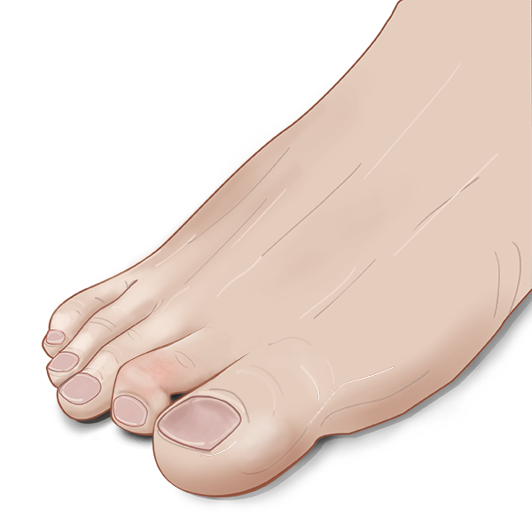 Mallet toe treatment in Cleveland, Ohio.